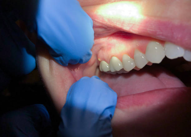 Best Urgent Tooth Repair  in Tiffin, OH